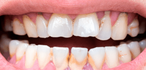 modafinil_teeth